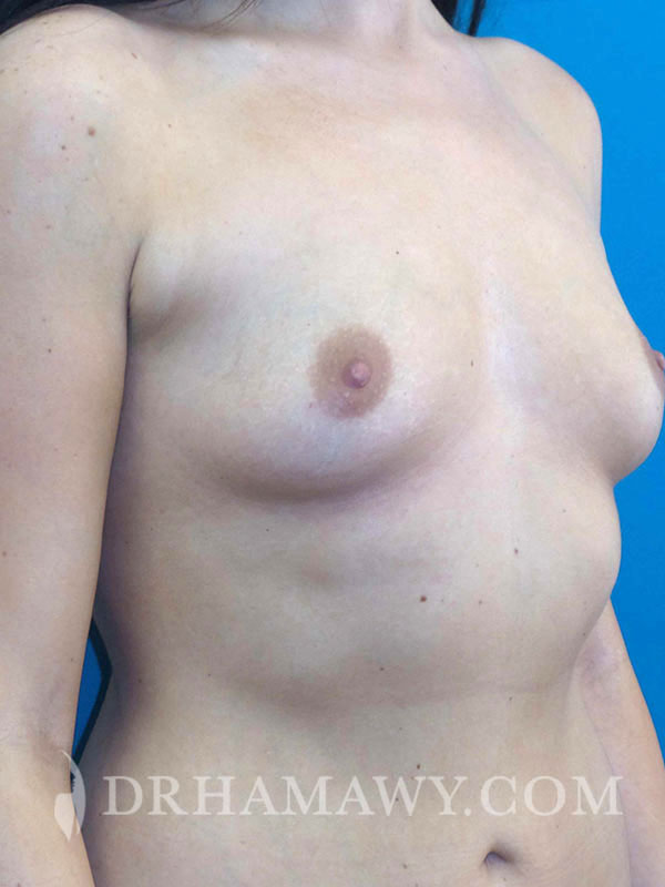 Breast Augmentation Before and After | Princeton Plastic Surgeons