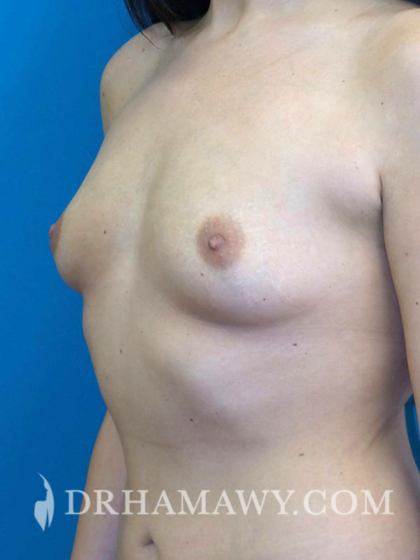 Breast Augmentation Before and After | Princeton Plastic Surgeons