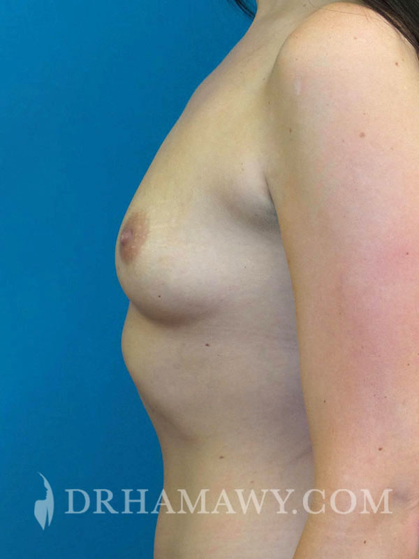 Breast Augmentation Before and After | Princeton Plastic Surgeons