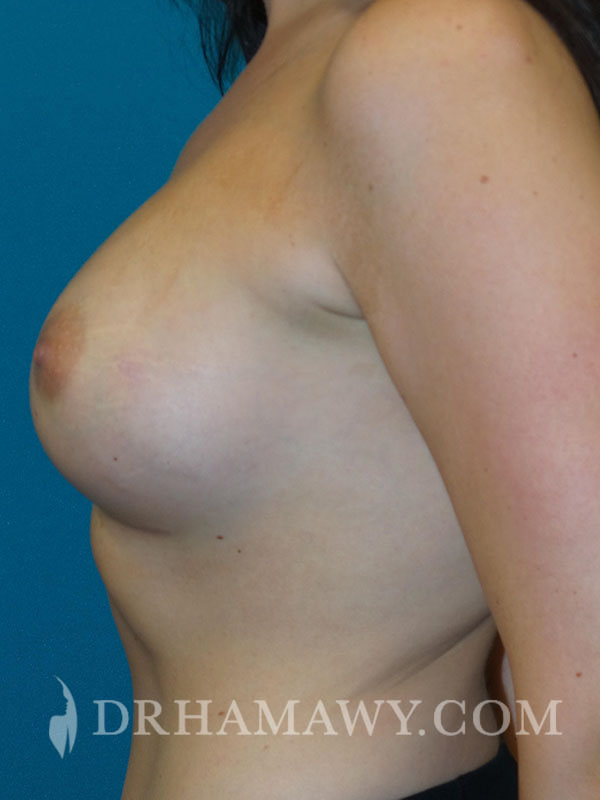 Breast Augmentation Before and After | Princeton Plastic Surgeons