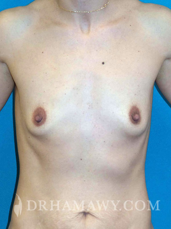 Breast Augmentation Before and After | Princeton Plastic Surgeons