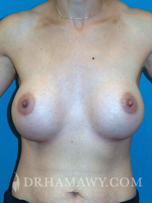 Breast Augmentation Before and After | Princeton Plastic Surgeons