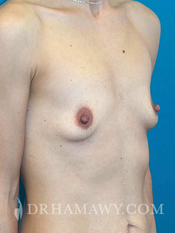 Breast Augmentation Before and After | Princeton Plastic Surgeons