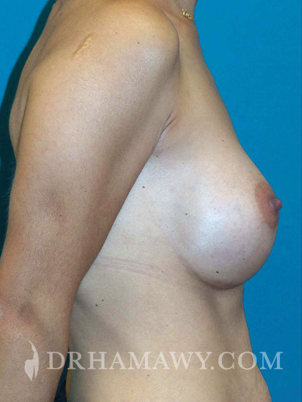 Breast Augmentation Before and After | Princeton Plastic Surgeons