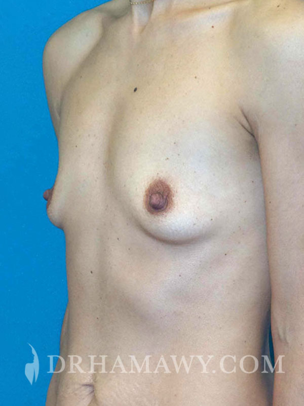 Breast Augmentation Before and After | Princeton Plastic Surgeons