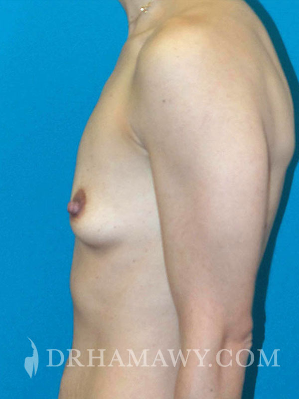 Breast Augmentation Before and After | Princeton Plastic Surgeons