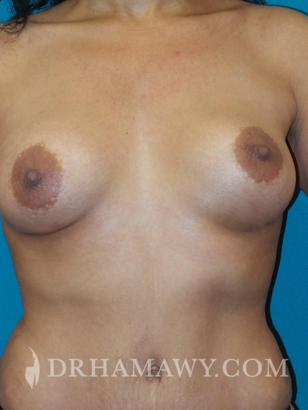 Breast Augmentation Before and After | Princeton Plastic Surgeons