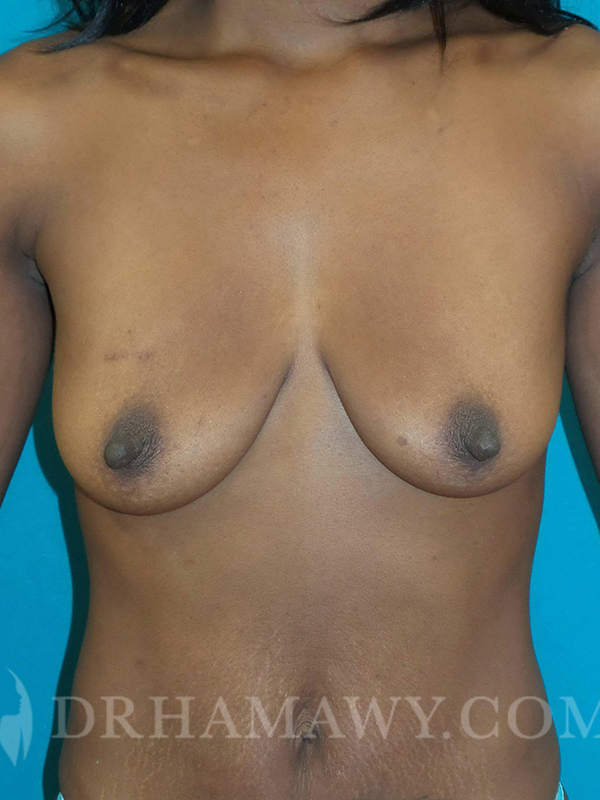 Breast Augmentation Before and After | Princeton Plastic Surgeons