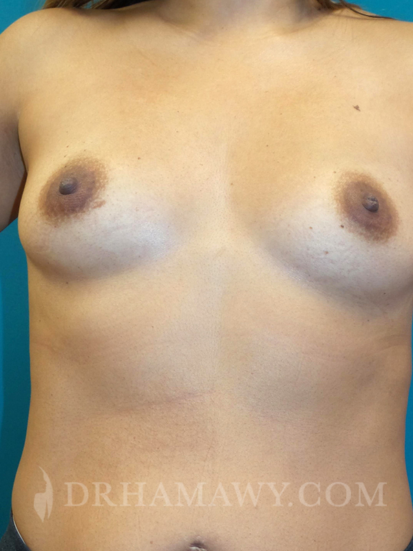 Breast Augmentation Before and After | Princeton Plastic Surgeons