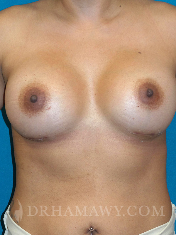 Breast Augmentation Before and After | Princeton Plastic Surgeons