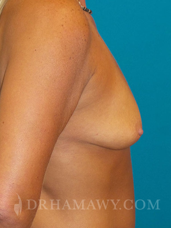 Breast Augmentation Before and After | Princeton Plastic Surgeons