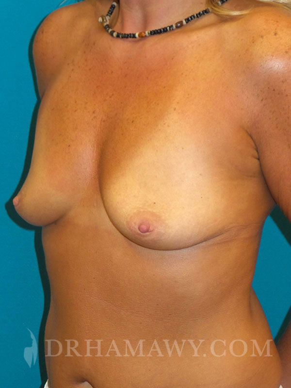 Breast Augmentation Before and After | Princeton Plastic Surgeons