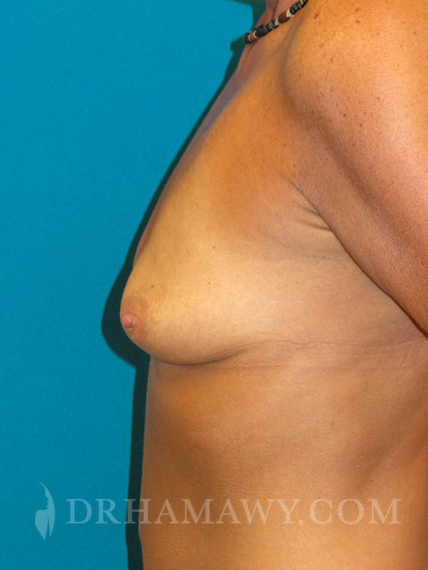 Breast Augmentation Before and After | Princeton Plastic Surgeons