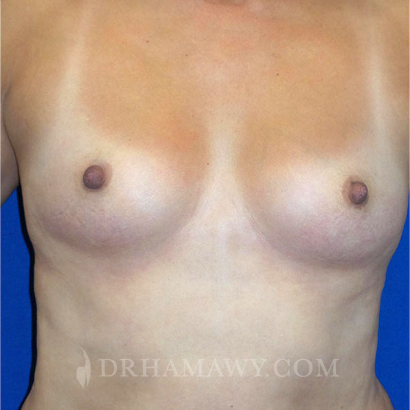 Breast Augmentation Before and After | Princeton Plastic Surgeons