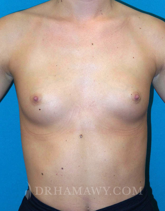 Breast Augmentation Before and After | Princeton Plastic Surgeons