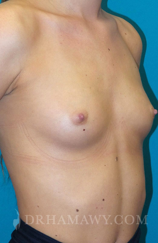 Breast Augmentation Before and After | Princeton Plastic Surgeons