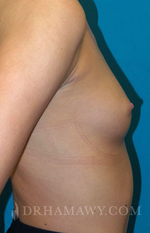 Breast Augmentation Before and After | Princeton Plastic Surgeons