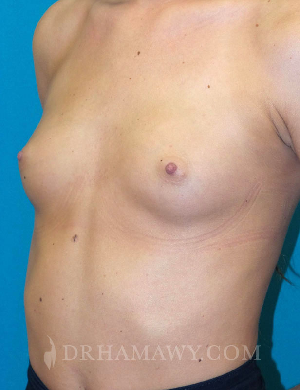 Breast Augmentation Before and After | Princeton Plastic Surgeons