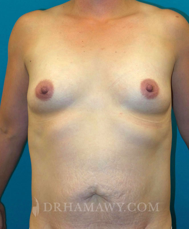 Breast Augmentation Before and After | Princeton Plastic Surgeons