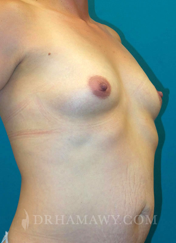 Breast Augmentation Before and After | Princeton Plastic Surgeons