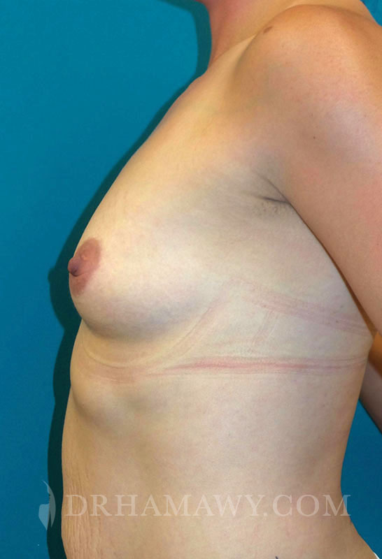 Breast Augmentation Before and After | Princeton Plastic Surgeons