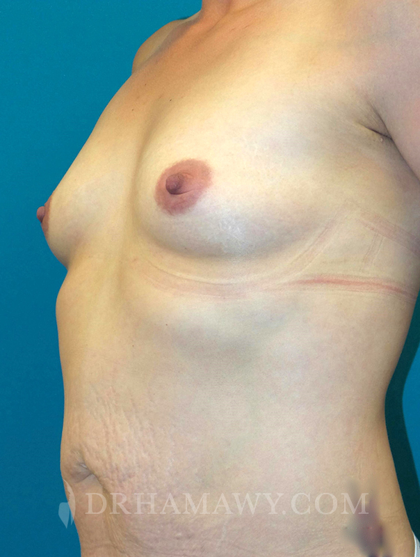 Breast Augmentation Before and After | Princeton Plastic Surgeons