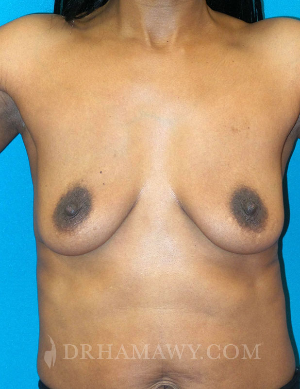 Breast Augmentation Before and After | Princeton Plastic Surgeons