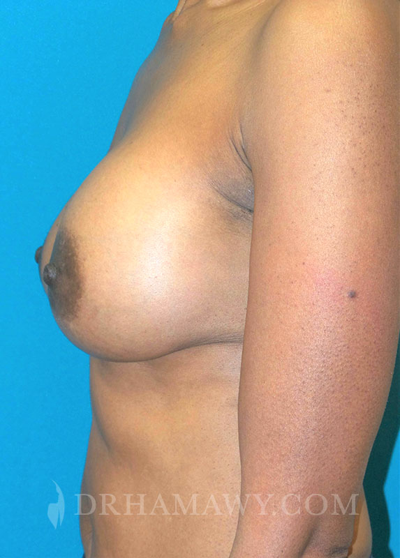 Breast Augmentation Before and After | Princeton Plastic Surgeons