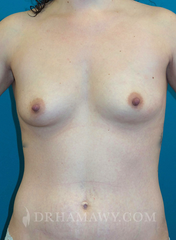 Breast Augmentation Before and After | Princeton Plastic Surgeons