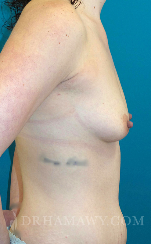 Breast Augmentation Before and After | Princeton Plastic Surgeons