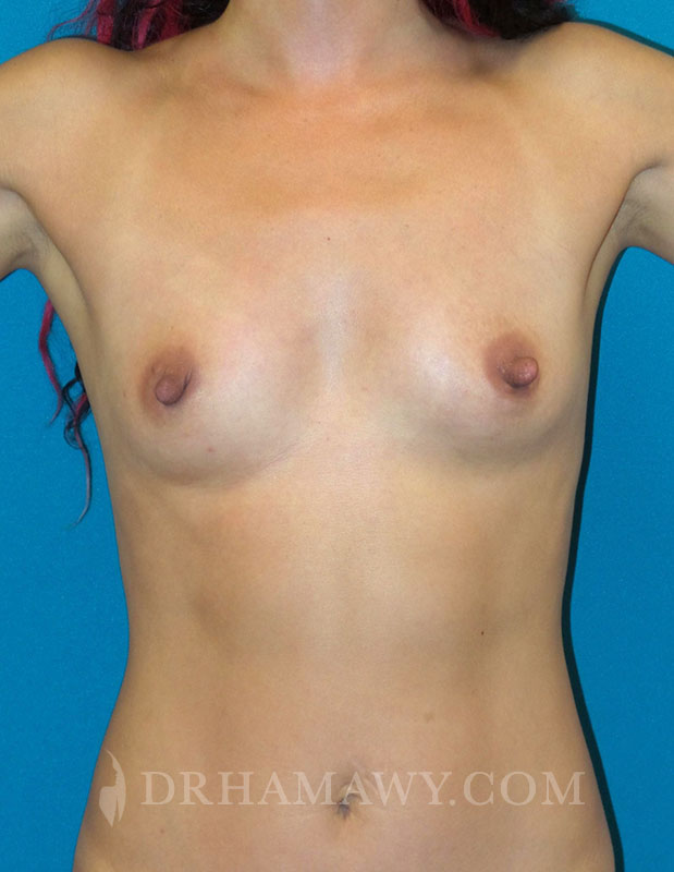 Breast Augmentation Before and After | Princeton Plastic Surgeons