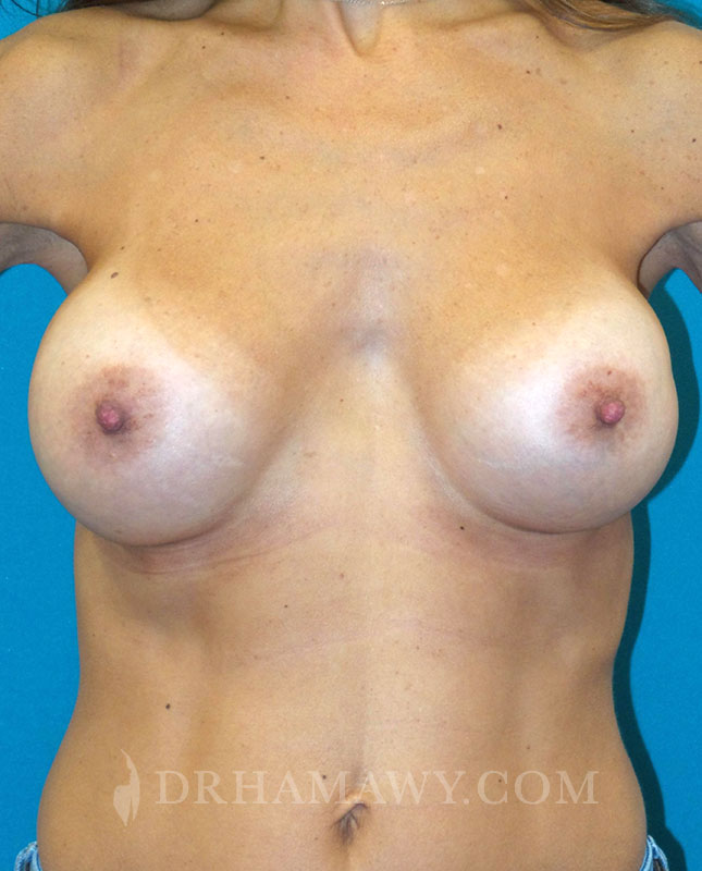 Breast Augmentation Before and After | Princeton Plastic Surgeons