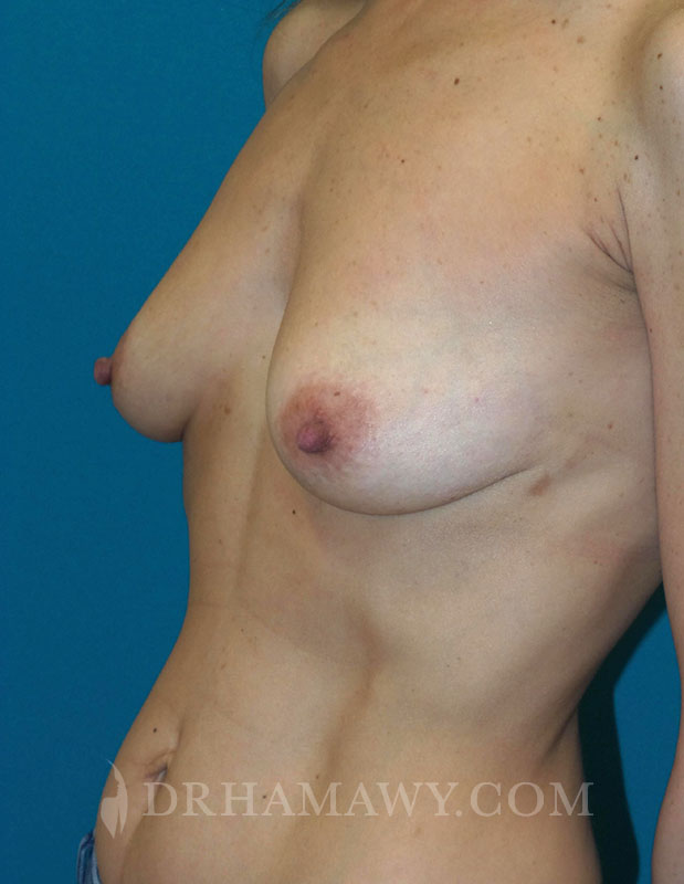 Breast Augmentation Before and After | Princeton Plastic Surgeons