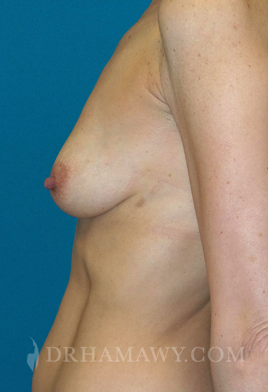 Breast Augmentation Before and After | Princeton Plastic Surgeons