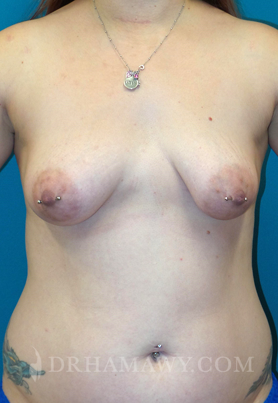 Breast Augmentation Before and After | Princeton Plastic Surgeons