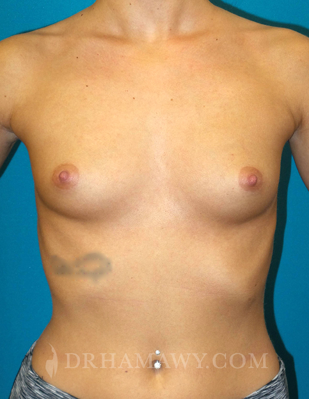 Breast Augmentation Before and After | Princeton Plastic Surgeons