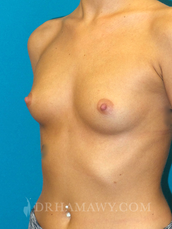 Breast Augmentation Before and After | Princeton Plastic Surgeons