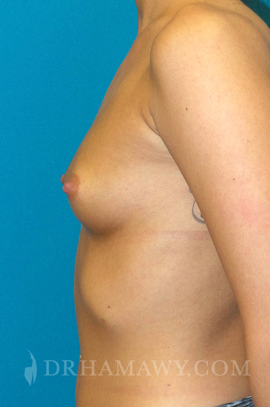 Breast Augmentation Before and After | Princeton Plastic Surgeons