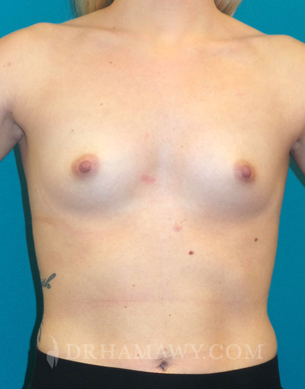 Breast Augmentation Before and After | Princeton Plastic Surgeons