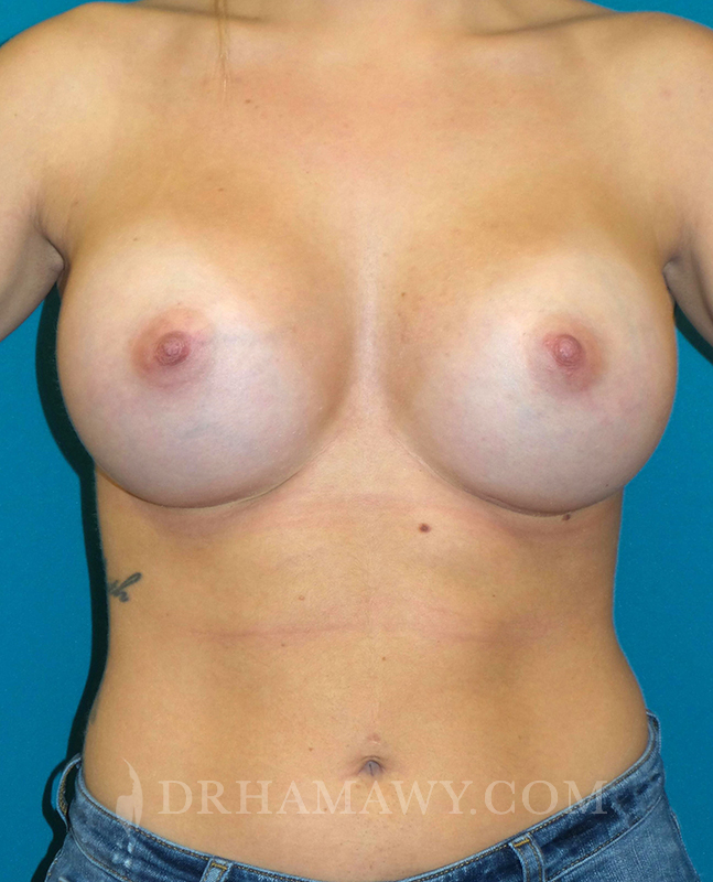 Breast Augmentation Before and After | Princeton Plastic Surgeons