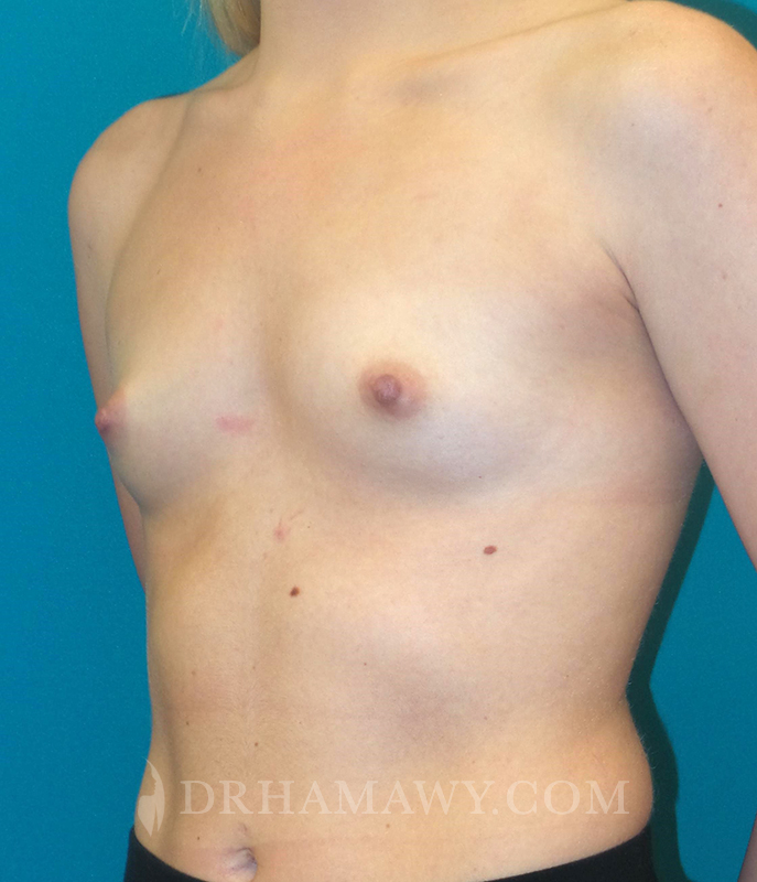 Breast Augmentation Before and After | Princeton Plastic Surgeons