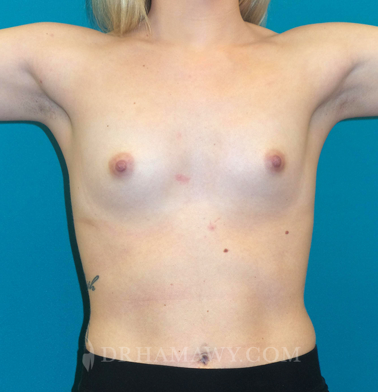 Breast Augmentation Before and After | Princeton Plastic Surgeons