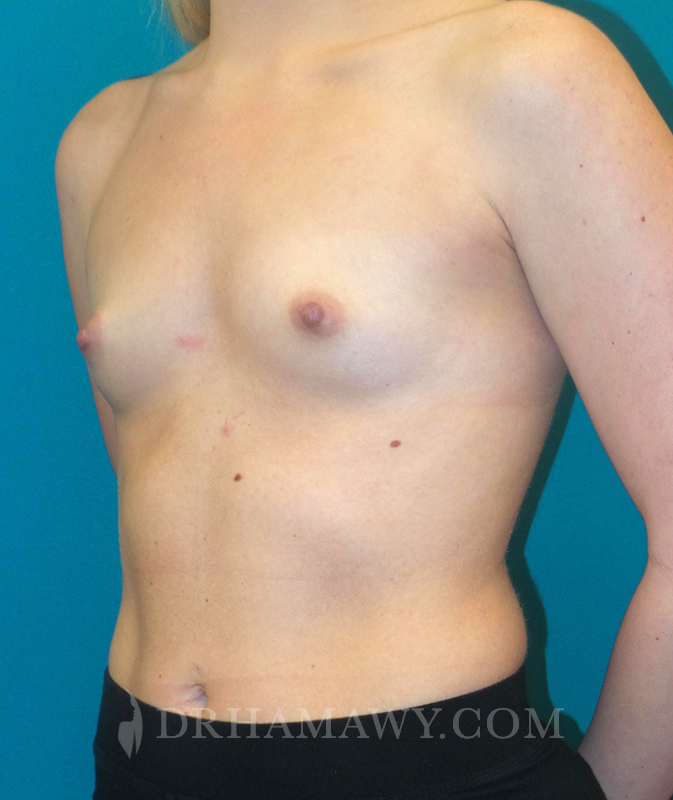 Breast Augmentation Before and After | Princeton Plastic Surgeons