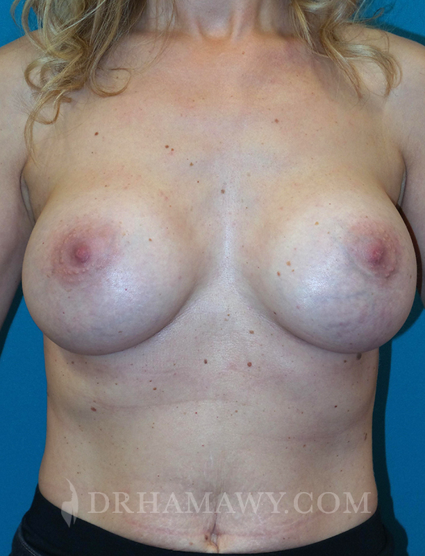 Breast Augmentation Before and After | Princeton Plastic Surgeons