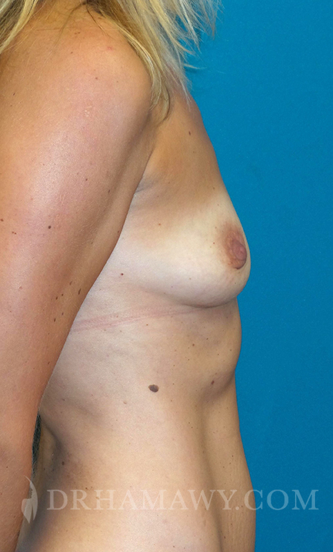 Breast Augmentation Before and After | Princeton Plastic Surgeons