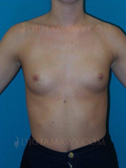 Breast Augmentation Before and After | Princeton Plastic Surgeons