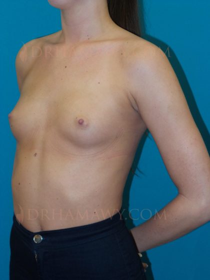 Breast Augmentation Before and After | Princeton Plastic Surgeons