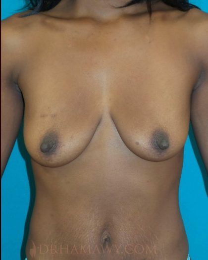 Breast Augmentation Before and After | Princeton Plastic Surgeons