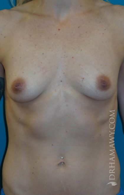 Breast Augmentation Before and After | Princeton Plastic Surgeons