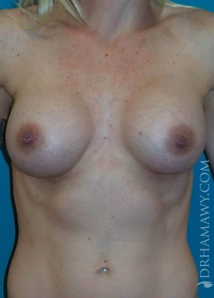 Breast Augmentation Before and After | Princeton Plastic Surgeons